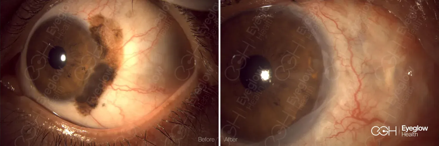 Ocular surface tumour managed by the Eyeglow Health surgical team in Istanbul — before and after surgical excision
