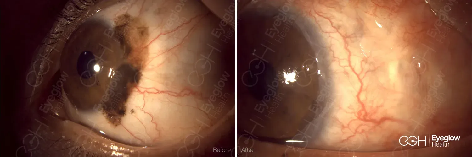 Conjunctival surface lesion managed by the Eyeglow Health surgical team in Istanbul — before and after surgical excision