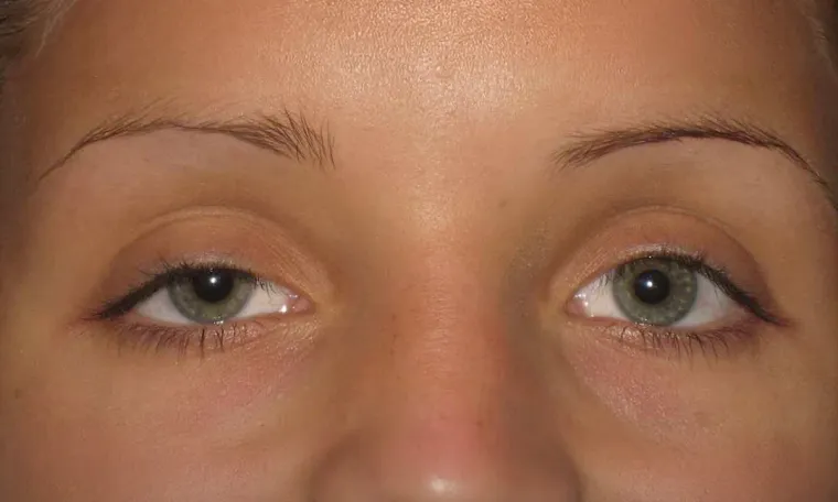 Ptosis Surgery