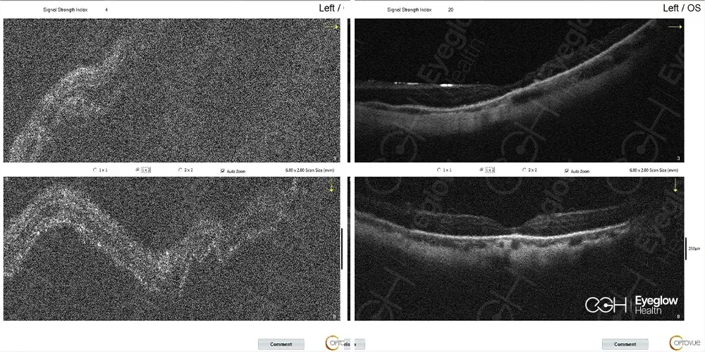Vitreoretinal surgery managed by the Eyeglow Health retina team in Istanbul — before and after surgical repair