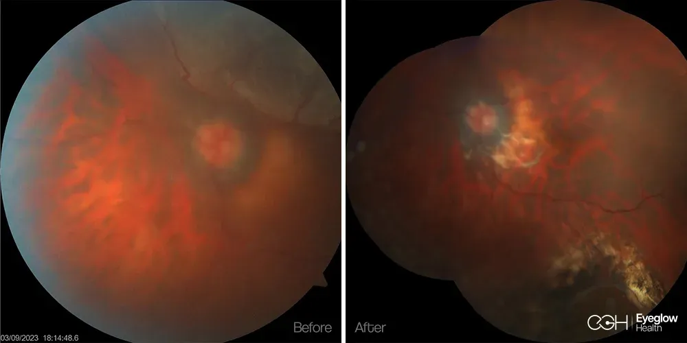 Retinal repair managed by the Eyeglow Health retina team in Istanbul — before and after vitrectomy