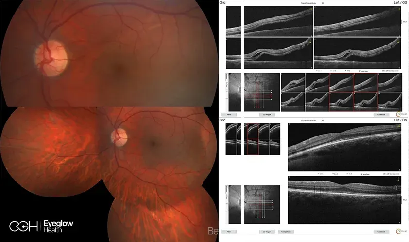 Clinical imaging from a vitreoretinal procedure at Eyeglow Health, Istanbul