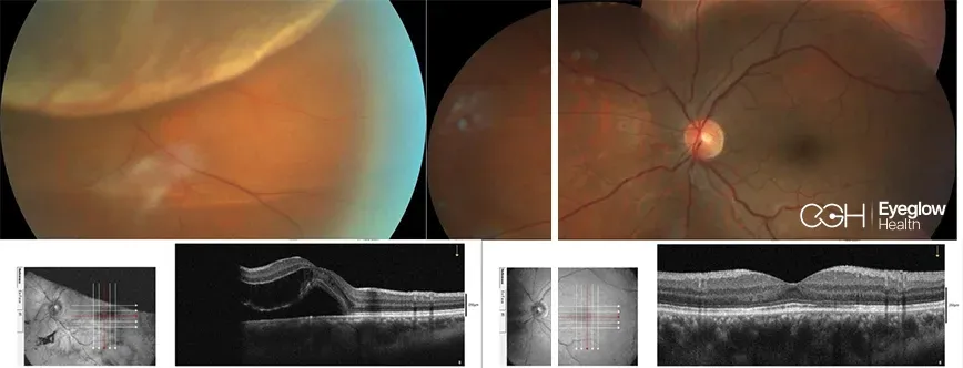 Clinical imaging from a vitreoretinal procedure at Eyeglow Health, Istanbul