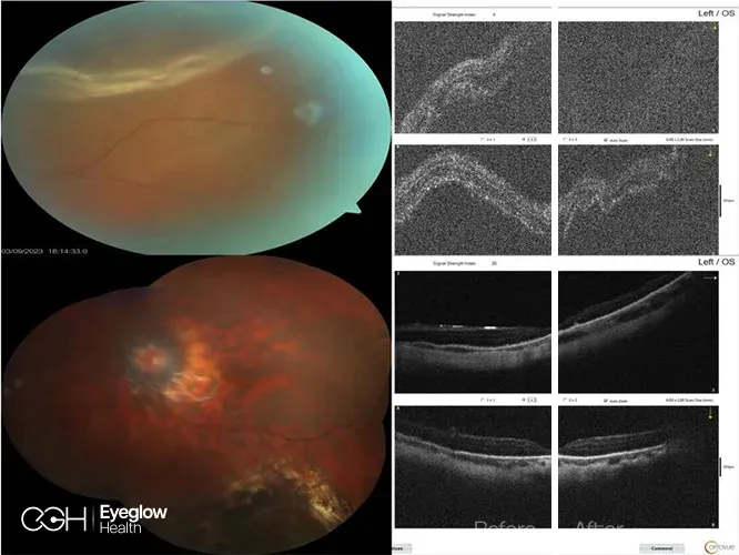 Clinical imaging from a vitreoretinal procedure at Eyeglow Health, Istanbul