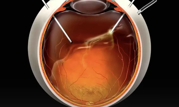Retinal Vitrectomy