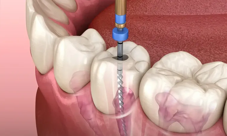Root Canal Treatment