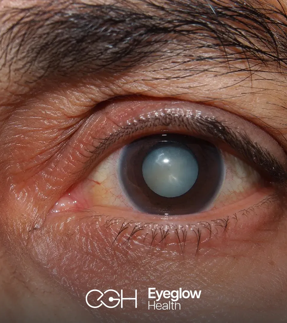 Smart Lens and LASIK refractive surgery options at Eyeglow Health, Istanbul