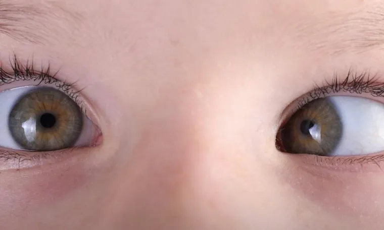 Strabismus Surgery