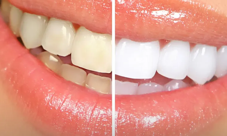 Teeth Whitening