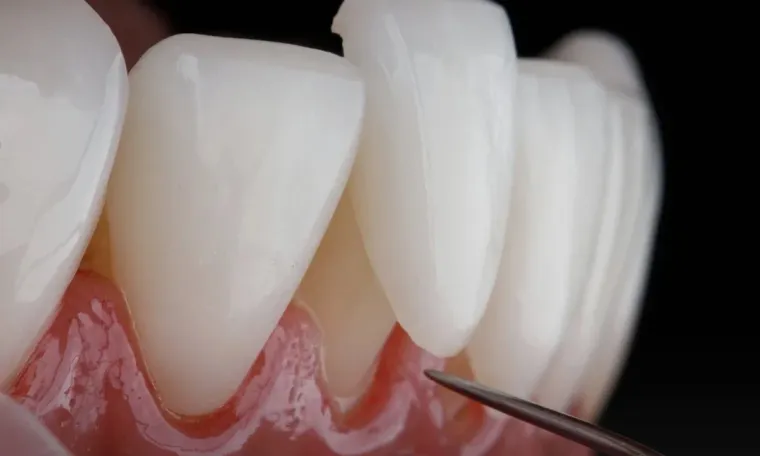 Veneers & Smile Design